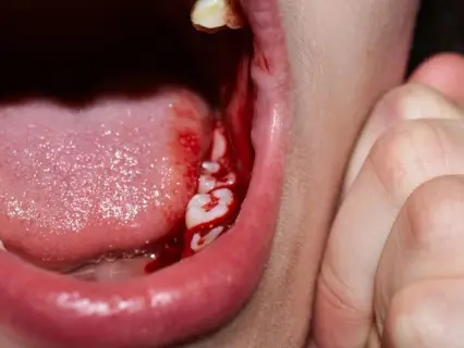 Possible Causes of Abscess or Dental Infection - Kid Grins