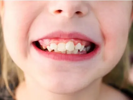 Reasons a child needs a tooth extraction - At Kid Grins they will explain why