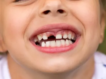 What to Do If your Child Knocks Out a Tooth - Kid Grins Are Experts With Knocked Out Teeth