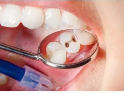 Why Dental Sealants Are Important for Kids - KidGrins